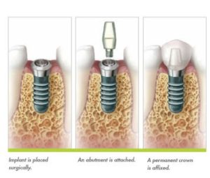 Implants