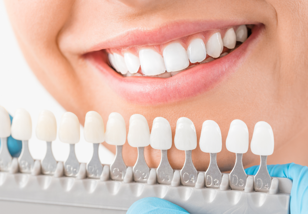Teeth Whitening for Sensitive Teeth