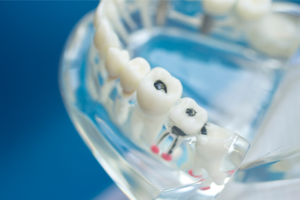 Dental Tooth Filling Mouth Model