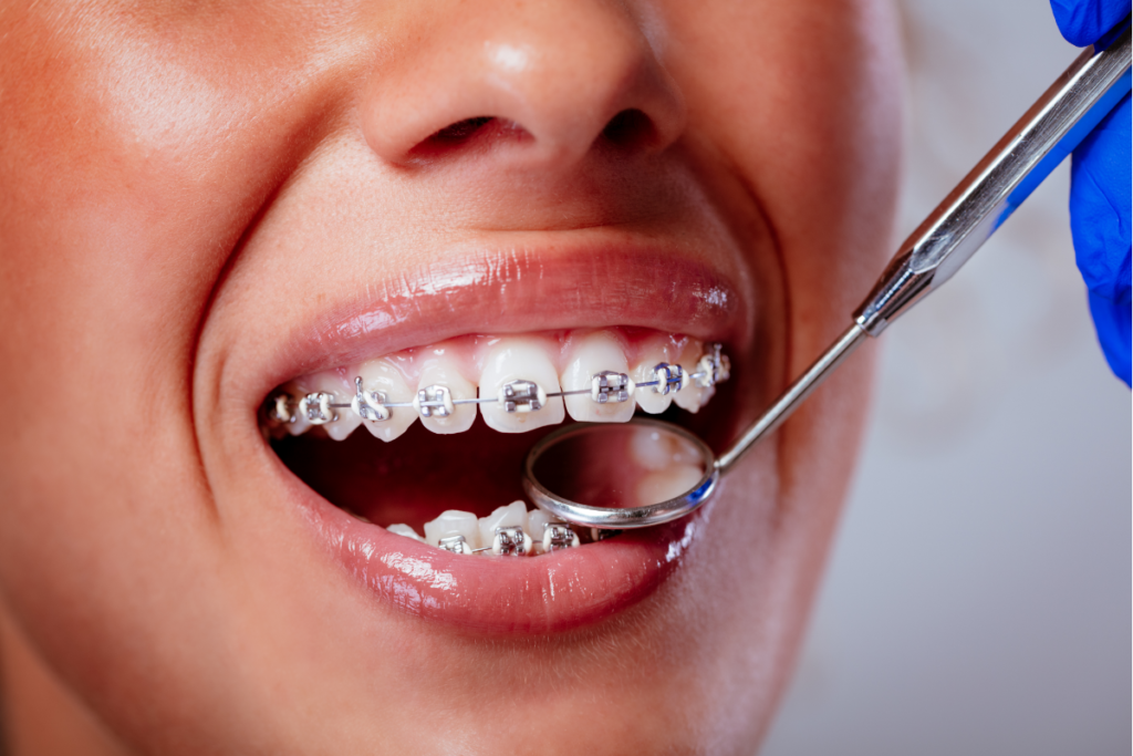checking braces